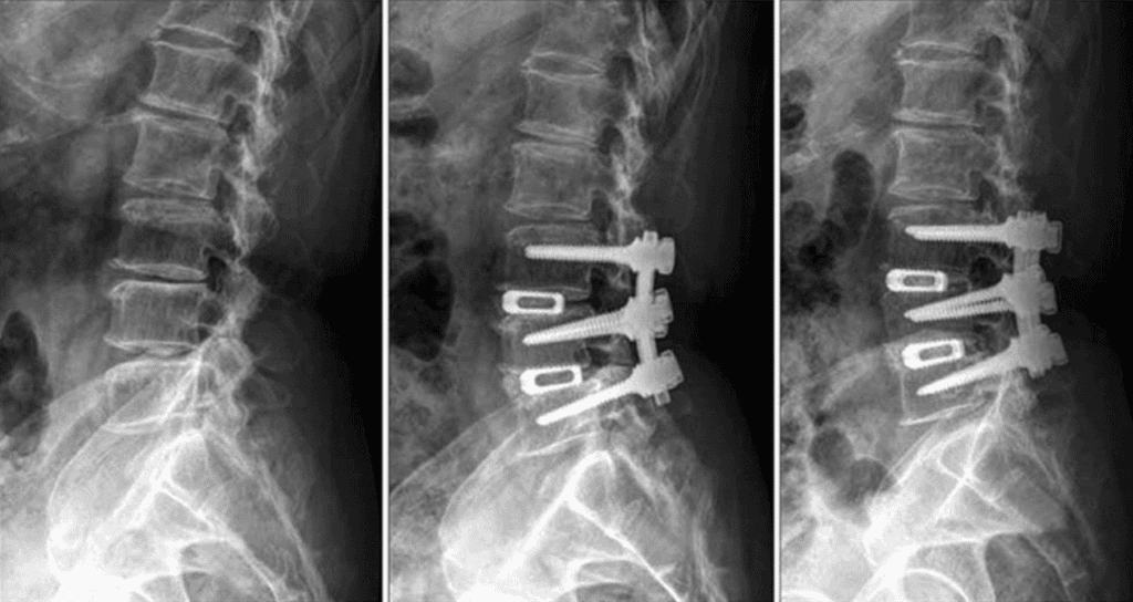 Lumbar Instrumented Fusion Spine Sure Clinic